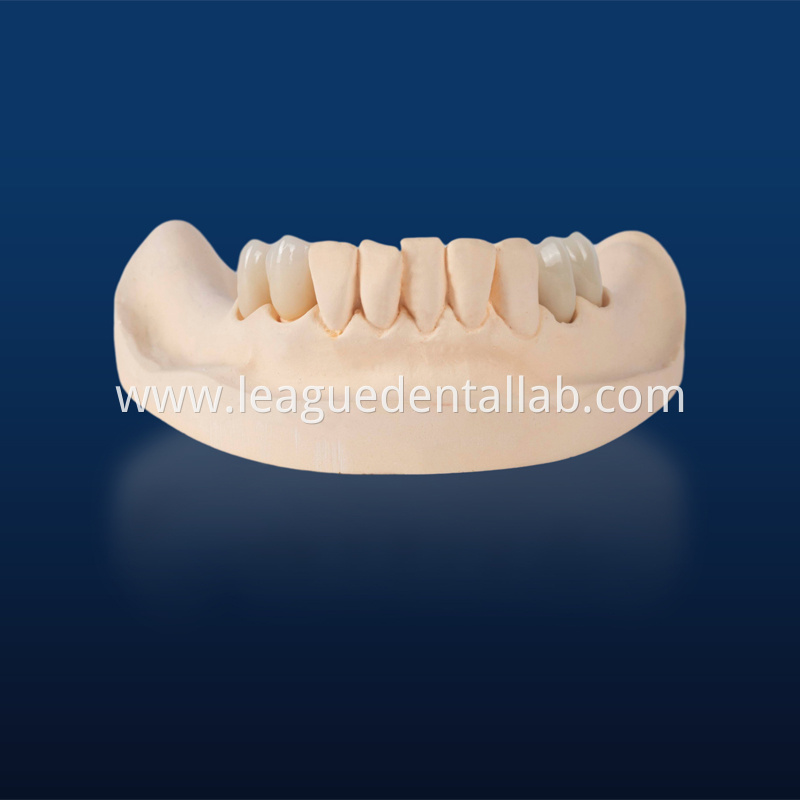 PFZ,Porcelain Fused to Zirconia,Zirconia Layered, Zirconia Veneered PFZ,Porcelain Fused to Zirconia,Zirconia Layered, Zirconia Veneered